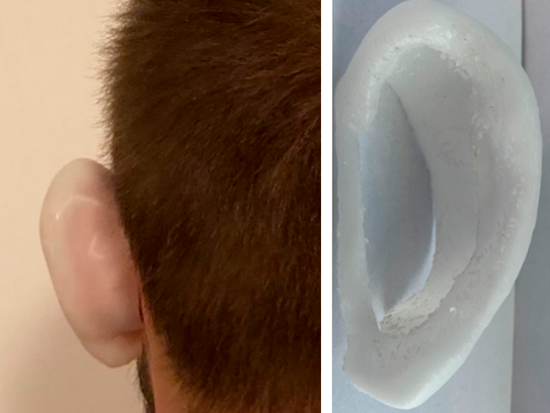 Una férula de oreja impresa en 3D con el filamento Facilan PCL 100